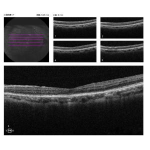3mm Fundus Optical Coherence Tomography Machine Checking Macular Degeneration