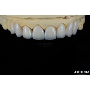 Glossy Surface Texture Feldspathic Veneer Natural Looking Porcelain Veneer