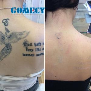 Professional Pigmentation Removal Q-Switched ND Yag Laser Machine Cooling System