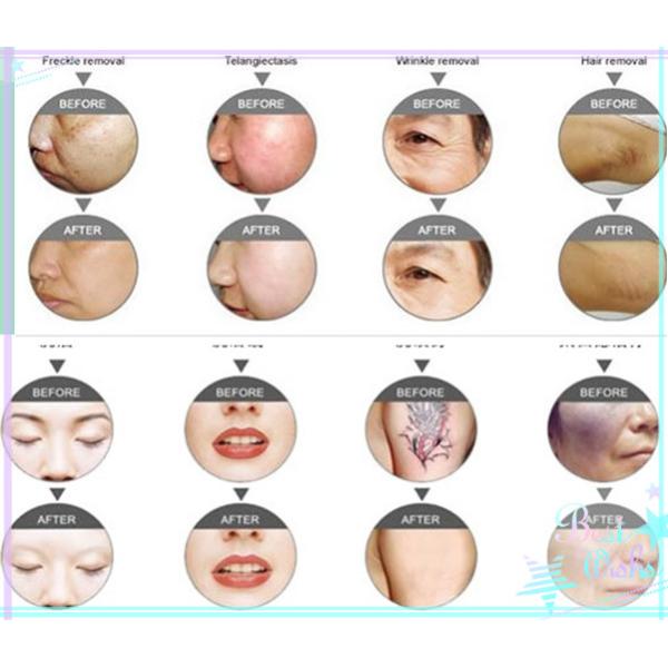 Multifunction SHR Super Hair Removal Machine 3 in 1 Bipolar RF Yag Laser Machine