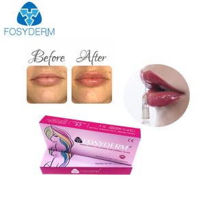 1ml hyaluronic acid lip fillers Derm Lip Enhancement Injection For Women