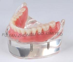 Cheap Dental 4 Implants Locator Lower Arch Model for sale