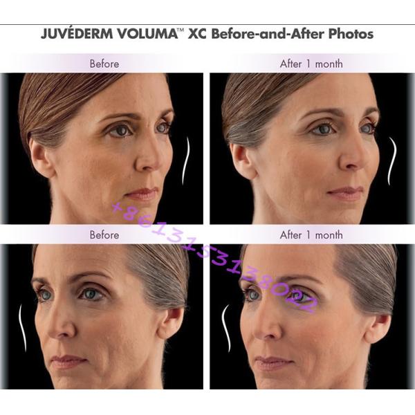 Juvederm Hyaluronic Acid Dermal Filler Juvederm Ultra Voluma 2×1ml