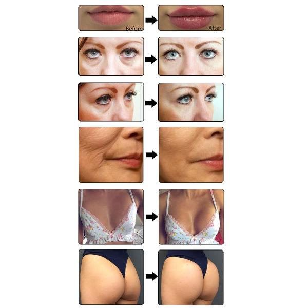 Poly L Lactic Acid Dermal Filler Cheek Butt Enlargement For Anti Aging Wrinkles