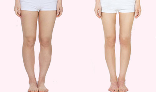 Professional Laser Liposuction Weight Loss Machine Lipolaser For Body Slimming Machine