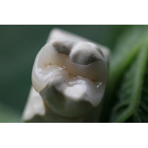 Fixed Prosthetics Permanent Solution EMAX Dental Crown