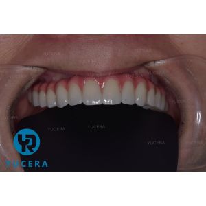 22mm 25mm Ceramic Dental Zirconia Block Self Colored ISO CE Certification used