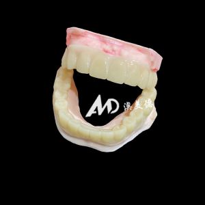 Lightweight PMMA Temporary Bridges with Hollow Design for Implant Restorations