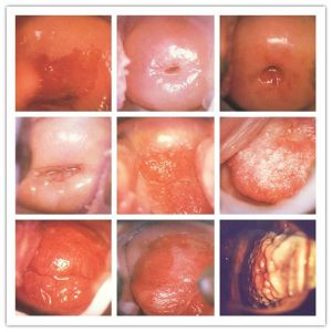 Lens Resolution 800000 Pixels Digital Electronic Colposcope With Automatic