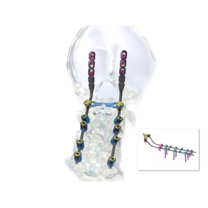 Posterior Cervical Internal Spine Fixation System , Pedicle Screw System