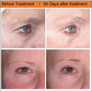 2 years warranty hifu hifu hifu wrinkle removal