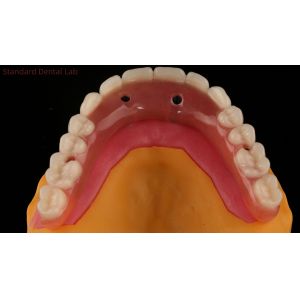 Acrylic Partial Implant Over Denture Titianium Bar Full Denture Teeth Set Up