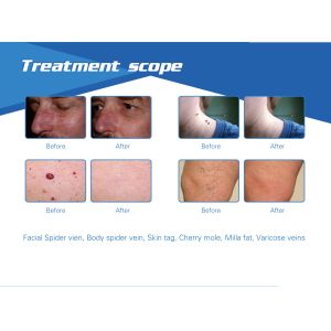 Best popular medical CE / FDA approval laser diode 980 nm spider vascular veins