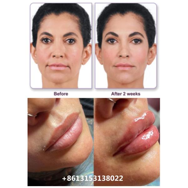 Juvederm Voluma Injectable Hyaluronic Acid Dermal Filler 2x1ml