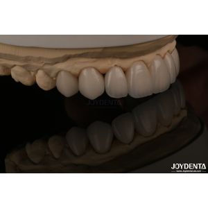 Feldspathic Natural Looking Cosmetic Veneers Precise Fit Highly Translucent