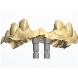 Natural-looking Zirconia Dental Crown with Excellent Biocompatibility and Cementable 3D Model