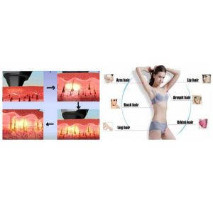Laser Emitter Diode Laser Hair Removal Machine With 'In-Motion'