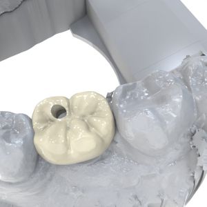 Flexible Permanent Crown Resin Strong Adhesion and Compatibility with Ceramic
