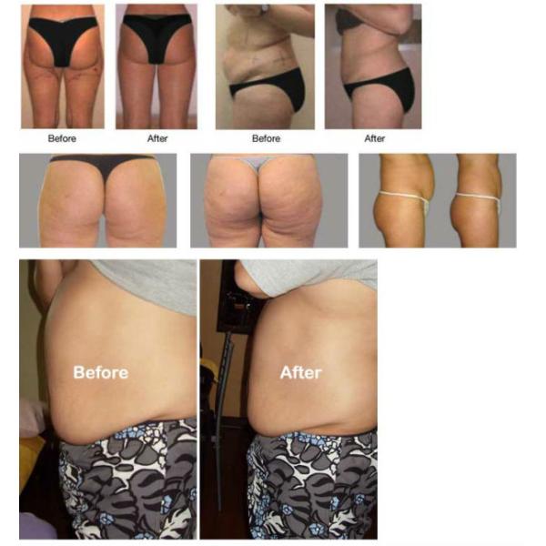 Professional Non Invasive Liposuction Machine For Vacuum Weight Loss / Body Slim