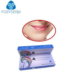 Smile Lines Hyaluronic Acid Dermal Filler Volume Derm Line Lyft Lidocaine Dermal