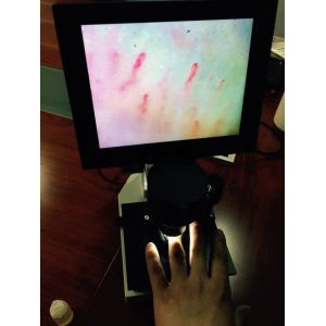 China Magnification 400 Times Digital Microcirculation Microscope Nailfold Microcirculation Equipment on sale