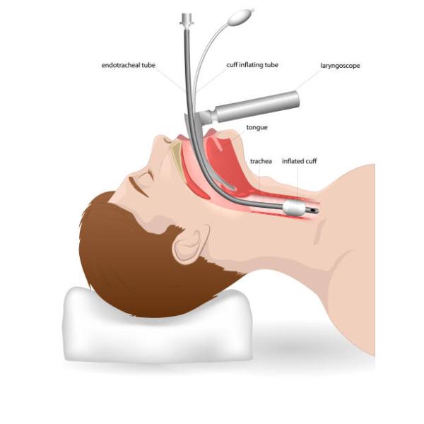 Oral EO Gas Sterile Medical Endotracheal Tube With Subglottic Suction