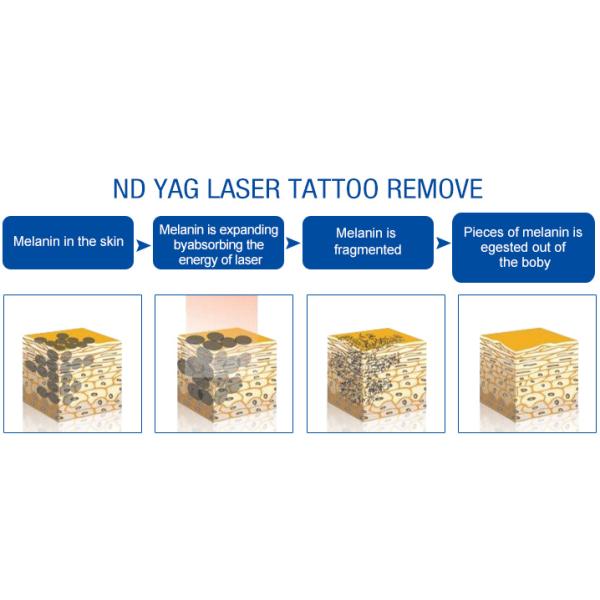 Professional 1064nm Permanent Tattoo Removal Machine Portable Q Switch Nd Yag