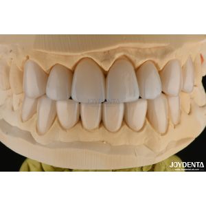 0.3-0.5mm Thick Feldspathic Porcelain Veneer High Fracture Resistance Upgrade