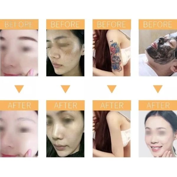 2 in 1 808 nm Diode Laser Hair Removal Laser Tattoo Removal Machine Instrument