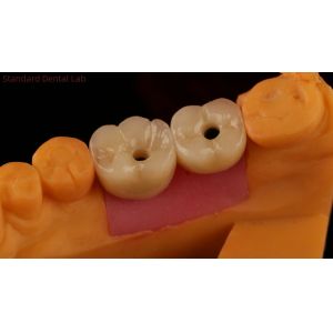 Porcelain Zirconia Cement Retained Screw Implant Hexagonal Head Shape for Custom