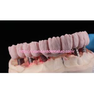 Implant Supported Zirconia Bridge With Titanium Abutment High Esthetics