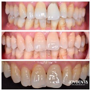 China Zirconia dentures that imitate natural teeth on sale