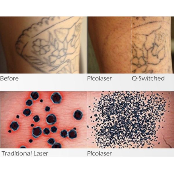 10Hz Picosecond Laser Machine 2HZ 5HZ Q Switch