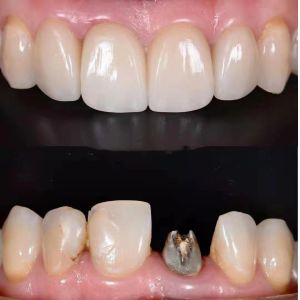 Yucera 3D Pro Multilayer Multilayer Zirconia Block Cad /cam System Ceramic Block