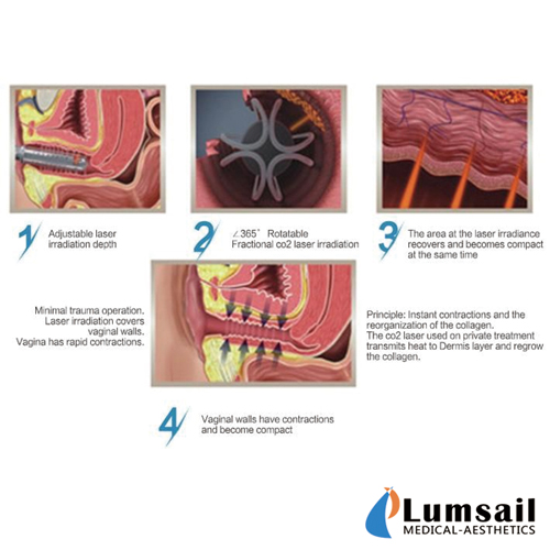 Stationary 30W Vaginal CO2 Fractional Laser Machine