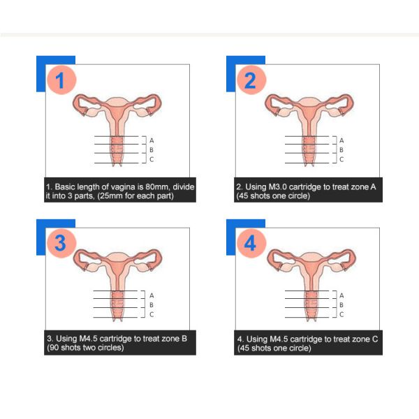 Painless Sama 4d 3d Hifu Machine Pressure Testor 4.5 Mm Cartridge Vaginal Probes
