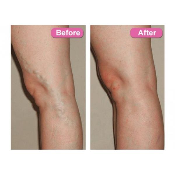 0.2Hz To 50KHz Varicose Veins Machine Portable 980nm Medical Diode Laser