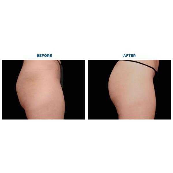 Fat Cell Cryoslimming Machine Cryotherapy 360 Cryoslim Fat Cell Freezing Machine