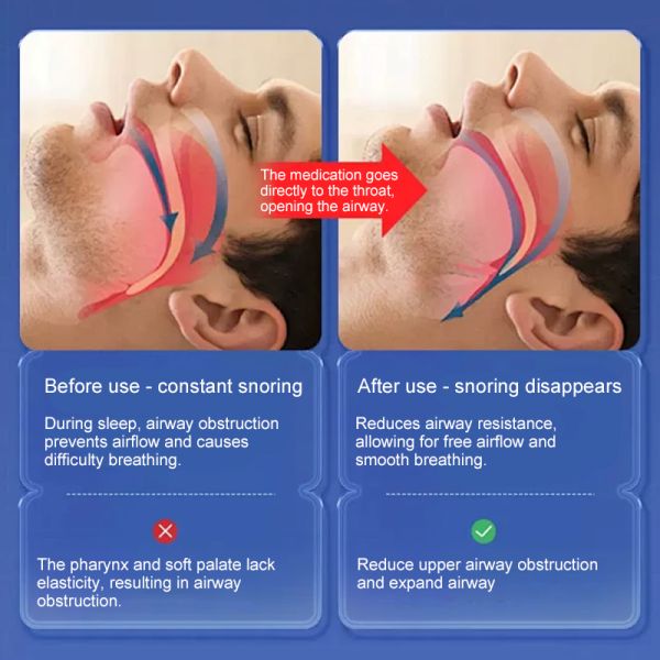 Renhe Liquid Anti-Snoring Device: Spray before bed for a comfortable sleep.
