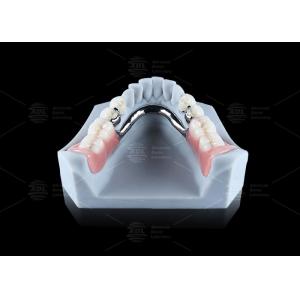 Titanium Dental Implant Ball Attachments Comfortable Secure Denture Retention