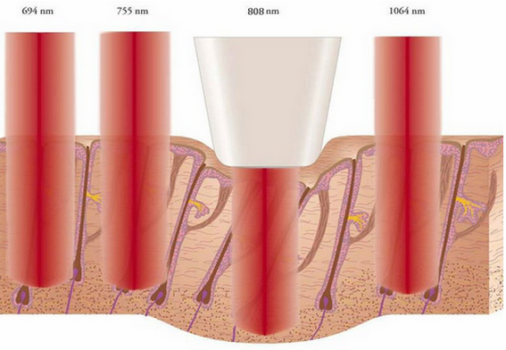 Germany laser emitter Permanent Hair Removal 808nm Diode Laser System