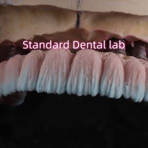 China Zirconia Implant Bridge Screw Retained With Pink Gum Porcelain on sale