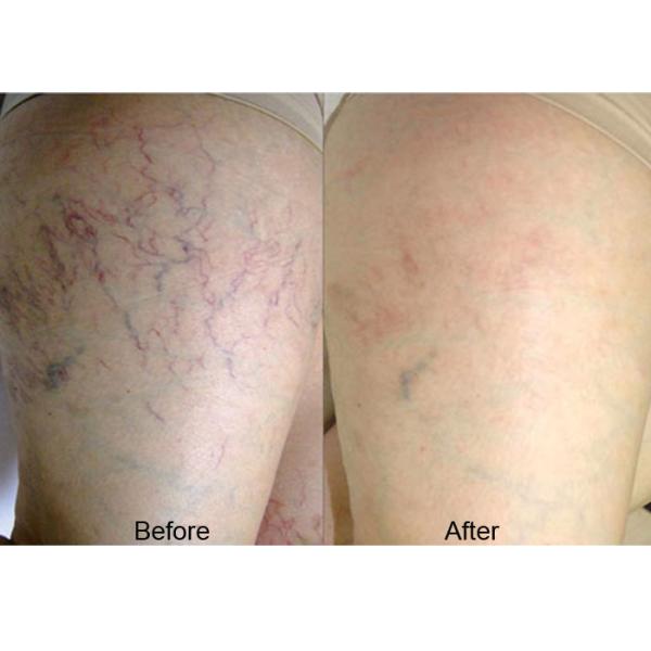 CW Thread Vein Removal Machine Berylas Minimally Invasive Laser