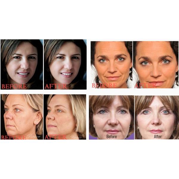 Face Injection Medical Sodium Hyaluronate Gel 1ml Fine / Derm / Deep Line Type