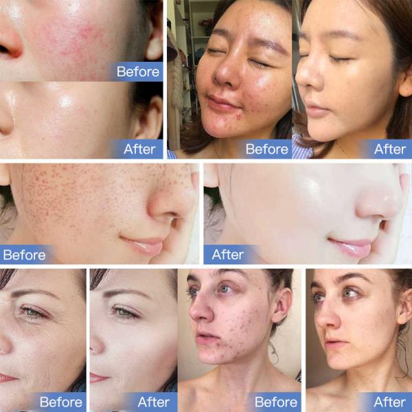 630nm 415nm PDT Machines Collagen Light Treatment With Red/Blue/Yellow/Green Colors