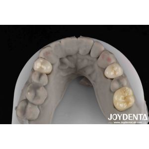 Easy Cementation Emax Inlay Onlay Medium Strength Natural-looking Esthetics