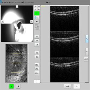 Eye Lesions Optical Coherence Tomography System Microscopic Screening