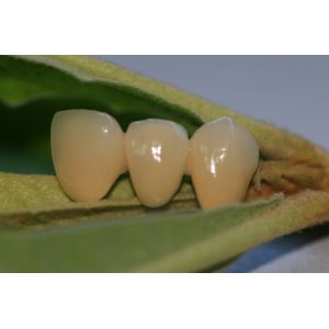 Resin Natural Colour Composite Temporary Crown For Anterior Teeth