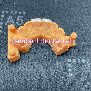 High Colour Stability Ivoclar Emax Laminate Veneers High Translucency