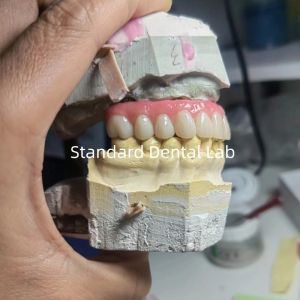 Screw Retained Titanium PMMA Dental Bridge Temporary Crown